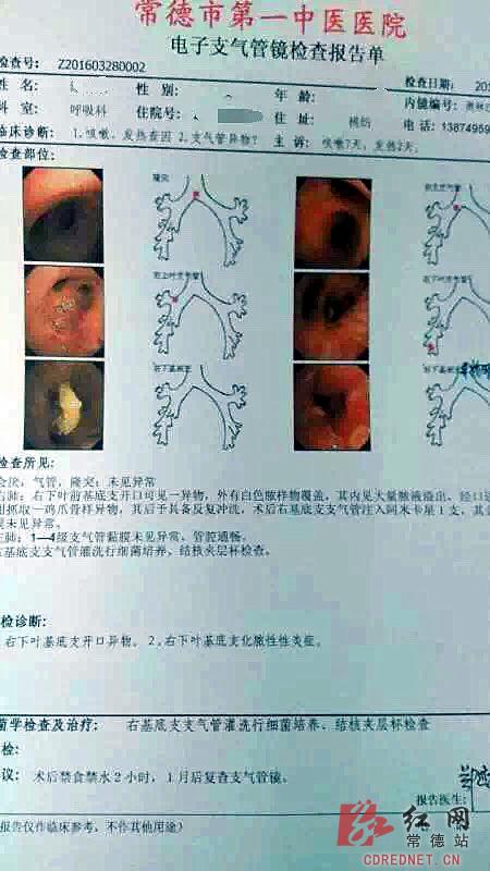 支气管镜检查结果