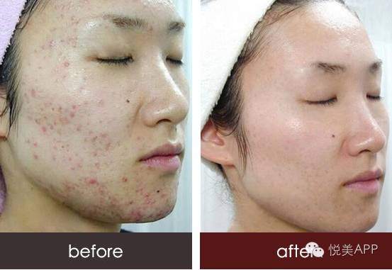 明星烂脸真可怕!简单粗暴,专治一脸爆痘痤疮|祛
