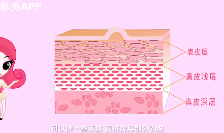 果酸换肤是一种化学剥脱术,疏通堵塞的毛孔,解决皮脂便秘,从根本上