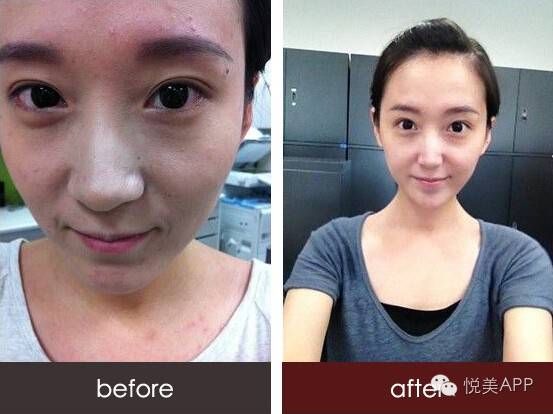 明星烂脸真可怕!简单粗暴,专治一脸爆痘痤疮|祛