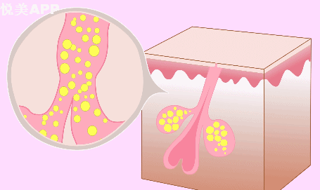 明星烂脸真可怕!简单粗暴,专治一脸爆痘痤疮|祛