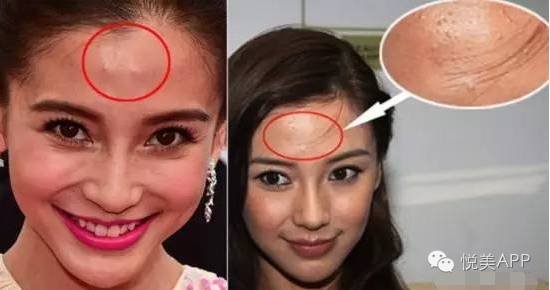 明星烂脸真可怕!简单粗暴,专治一脸爆痘痤疮|祛