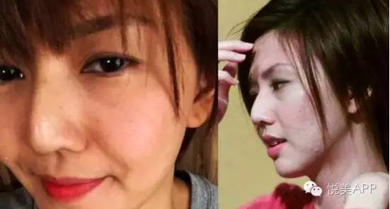 明星烂脸真可怕!简单粗暴,专治一脸爆痘痤疮|祛