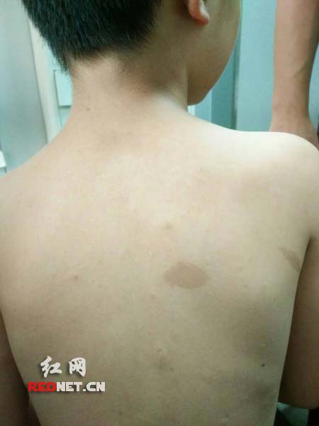 十岁男童罹患罕见遗传病 右眼变形视力下降|神