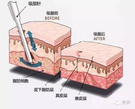 减肥不减胸,形体美才是真的美!|水动力吸脂|负压