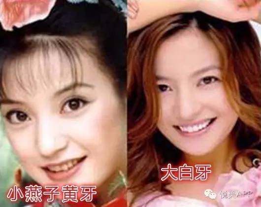你是地包天?都以为明星好当,原来偷偷做了截骨术