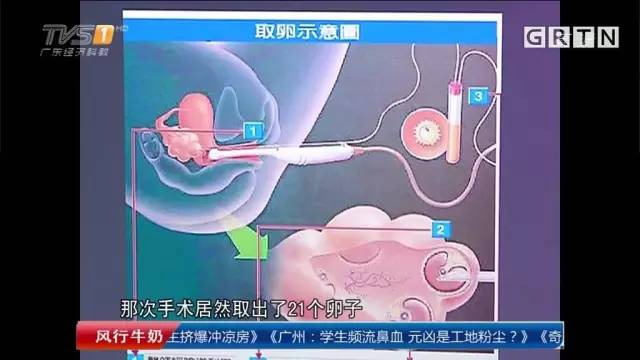 21颗卵子换了1万块！17岁女生卵巢肿如孕妇、到处破孔，或终身不孕……