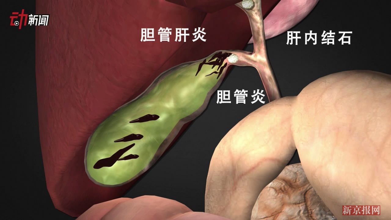 3D：吃鱼虾警惕肝吸虫病！我国感染人数超千万