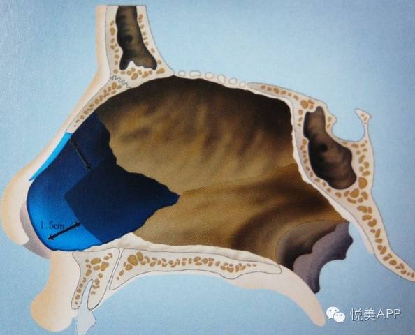 鼻中隔软骨?你造是怎么取出来的?|耳软骨|鼻中