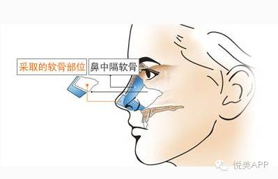 鼻中隔软骨你造是怎么取出来的