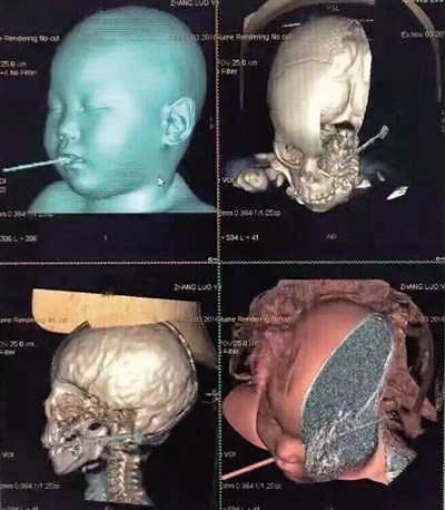 希希脑部CT图。