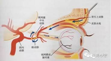 【良心说】注射填充剂是怎么导致失明的?|填充