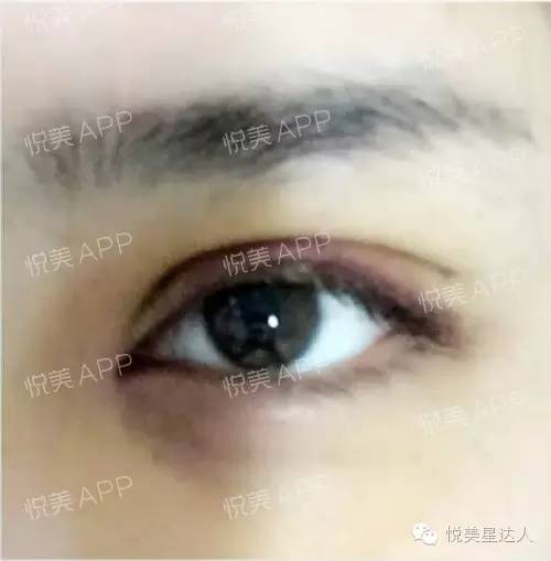 让眼睛变大用什么美瞳,让眼睛变大的手术都有哪些