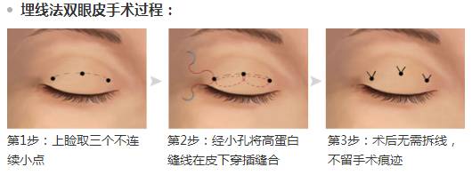 线雕提升怎么避免踩坑 靠谱医院医生选择指南