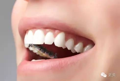 揭内幕 | 隐形牙套凭啥比普通牙套价格高五倍?