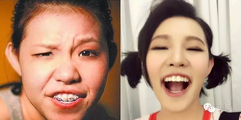 揭内幕 | 隐形牙套凭啥比普通牙套价格高五倍?