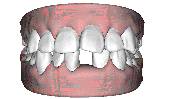 揭内幕 | 隐形牙套凭啥比普通牙套价格高五倍?