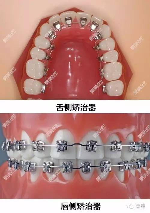 总结下舌侧牙套的优点▼   1,特别隐形.