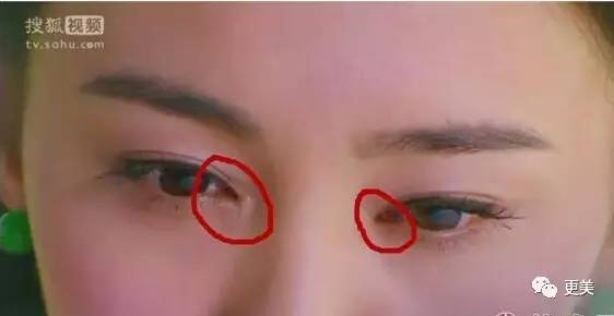 整形手术到底会不会留疤?怎么判断自己是疤痕