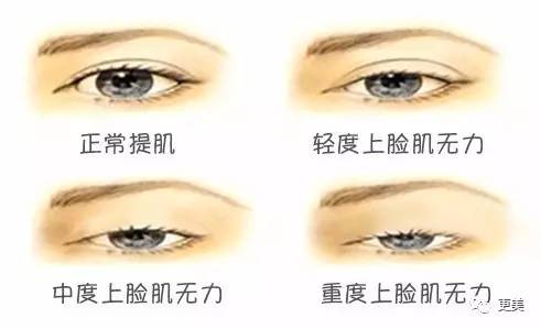 Baby、杨幂这些女星竟然都是大小眼,解决办法