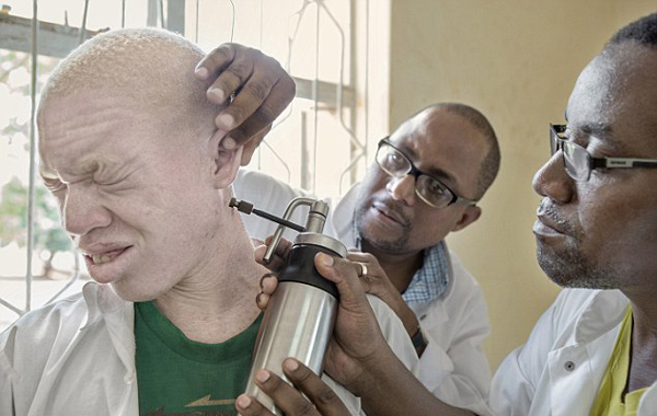 马拉维白化病患者悲惨境遇:受歧视被杀害肢解