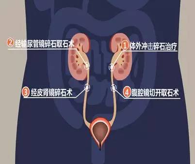 无法自然排出的大结石应采取外科治疗方式.