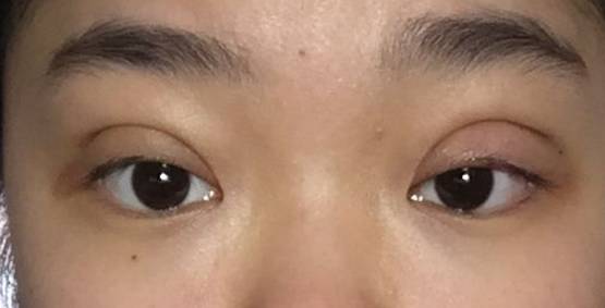 双眼皮不自然、失败?修复是个大事儿(上).