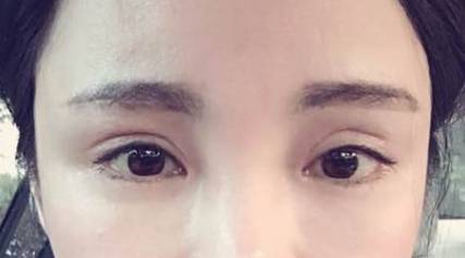 双眼皮不自然、失败?修复是个大事儿(上).