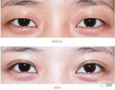 怎么才能找到合适的双眼皮 sRf5-fycapec1060133.jpg