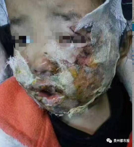 三星手机又爆炸 5岁女童双手及脸部被烧伤