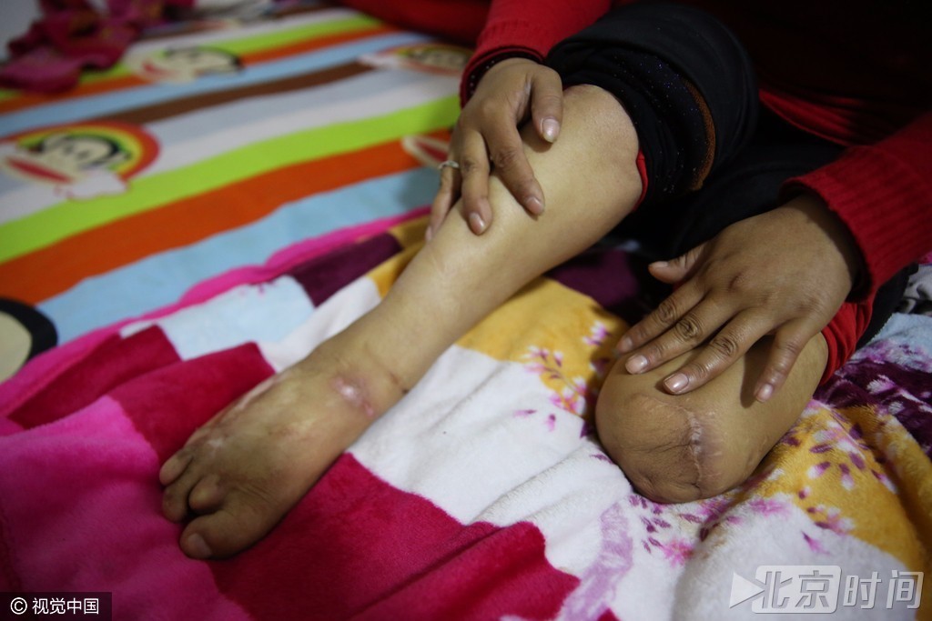 27岁"独脚女孩"曾自杀8次 如今花光积蓄做公益_新浪财经_新浪网