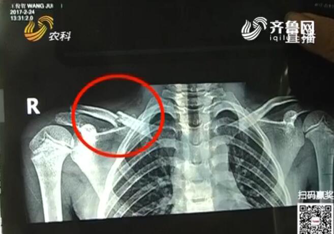 因没带作业本 枣庄七岁男童被打锁骨骨折