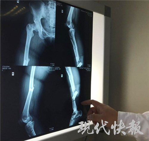 女子骑车回家遇车祸 右腿7处骨折断成8截