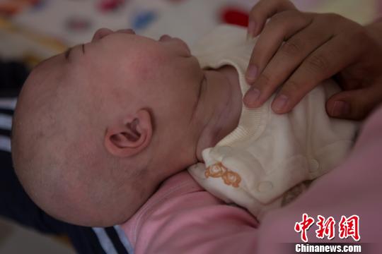 孩子出生后第15天,于丽静发现小坚果颈部右边比左边粗,而且长出了花生米大小的包块。孩子满月时已长到鸡蛋黄那么大。图为术后小坚果的脖颈处留下的伤疤。 范丽芳 摄