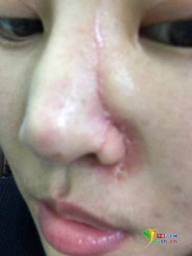 “丽江被打毁容女子”琳哒发布的近照，面部疤痕明显。