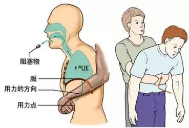 鱼刺卡在扁桃体照片_鱼刺卡在喉咙怎么办