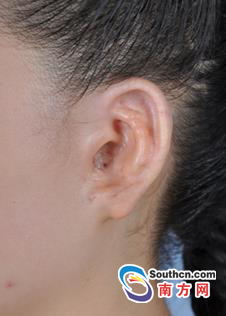 圳引进中国器官再造第一人:用肋骨再造耳朵|整