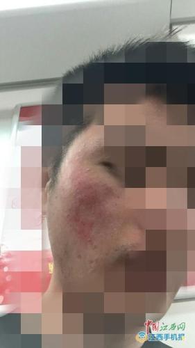 受害学生脸部出现疤块、红肿。