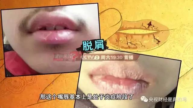 嘴唇总是起皮,也许不只是干……太可怕了!