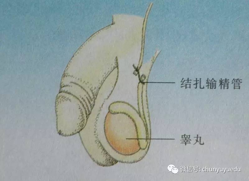 男性射精需要泄精,射精,尿道内口闭合这三个步骤,而男性结扎只是将