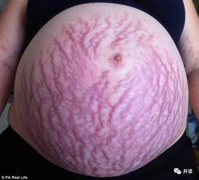孕妇肚子突然布满条纹,原来是对孩子过敏