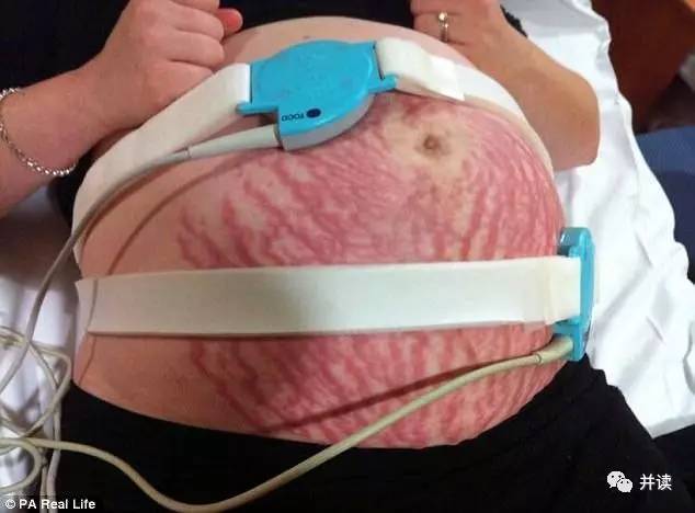 孕妇肚子突然布满条纹,原来是对孩子过敏|过敏
