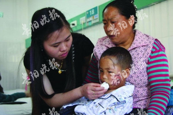 脸部缝合的小叶