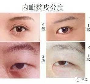 做什么运动可以瘦上眼皮 MSWq-fyfeutq0159049.jpg