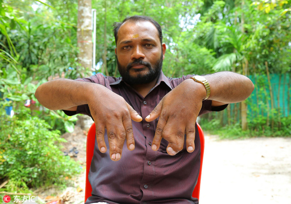 印度一家族世代长蹼指 拒绝手术怕天降厄运|厄