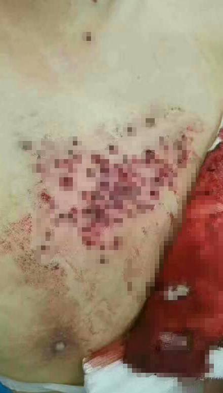 广西数名蒙面男持火药枪进超市扫射 村民胸部中枪