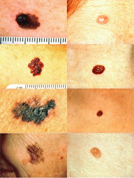 5个小贴士:通过观察痣判断皮肤癌|皮肤癌|癌症|皮肤_新浪科技_新浪网