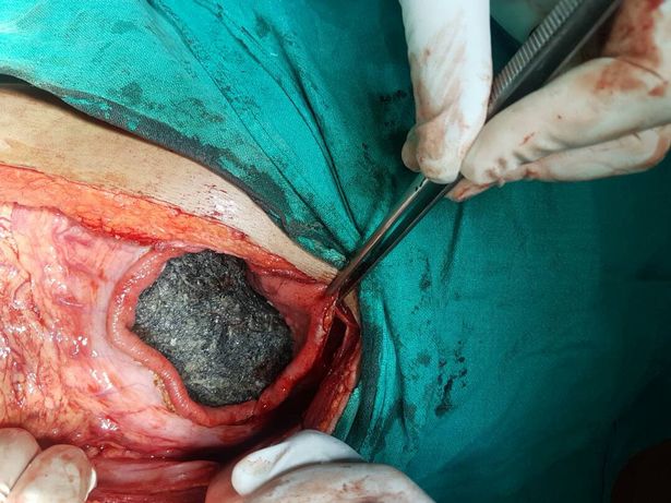 印16岁暴瘦女孩患食毛症 医生从胃部取出2公斤