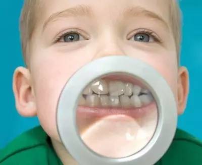 你家有小歪牙吗?暑期正畸旺季,100份专属礼