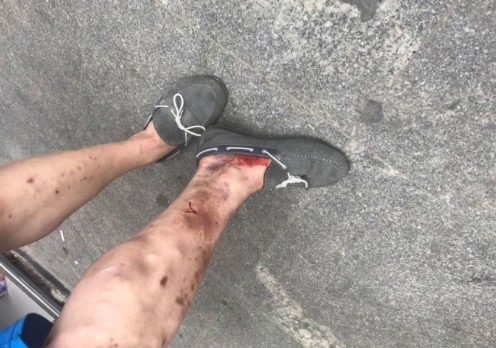 唐冶煤气爆炸事故查明，一名重伤员抢救无效不幸身亡